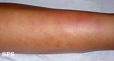 erythema nodosum