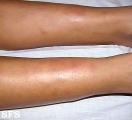 erythema nodosum