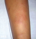 erythema nodosum