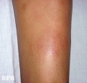 erythema nodosum