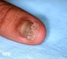 onychomycosis