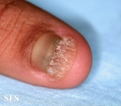 onychomycosis