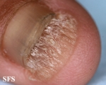 onychomycosis
