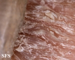 onychomycosis