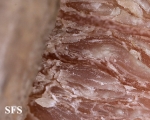 onychomycosis