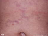 antiphospholipid antibody syndrome