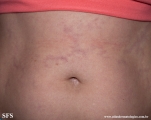 antiphospholipid antibody syndrome