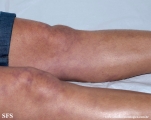 antiphospholipid antibody syndrome