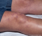 antiphospholipid antibody syndrome