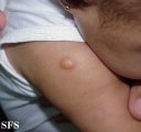 mastocytoma-solitary mastocytoma