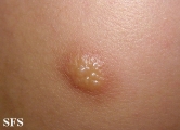 mastocytoma-solitary mastocytoma