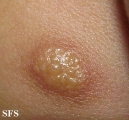 mastocytoma-solitary mastocytoma