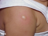 mastocytoma-solitary mastocytoma