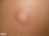 mastocytoma-solitary mastocytoma