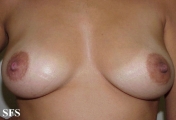 paget's disease