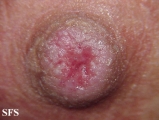 paget's disease