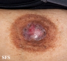 paget's disease