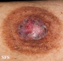 paget's disease