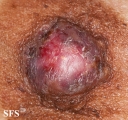 paget's disease