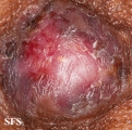 paget's disease