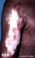 lupus vulgaris