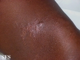 lupus vulgaris