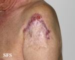 lupus vulgaris