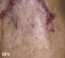 lupus vulgaris