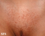syringoma-vulvar syringoma