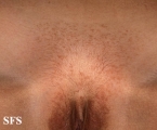 syringoma-vulvar syringoma