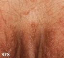 syringoma-vulvar syringoma