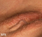 syringoma-vulvar syringoma