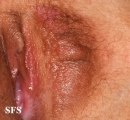syringoma-vulvar syringoma