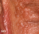 syringoma-vulvar syringoma