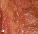 syringoma-vulvar syringoma