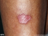 porokeratosis of mibelli