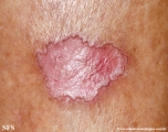porokeratosis of mibelli