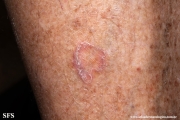 porokeratosis of mibelli