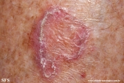 porokeratosis of mibelli