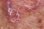 porokeratosis of mibelli