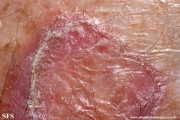 porokeratosis of mibelli