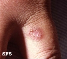 porokeratosis of mibelli