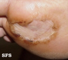 porokeratosis of mibelli