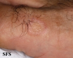 porokeratosis of mibelli