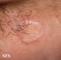 porokeratosis of mibelli