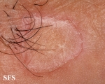 porokeratosis of mibelli