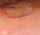 porokeratosis of mibelli