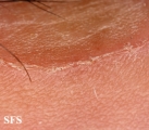 porokeratosis of mibelli