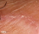 porokeratosis of mibelli