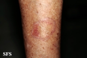 porokeratosis of mibelli